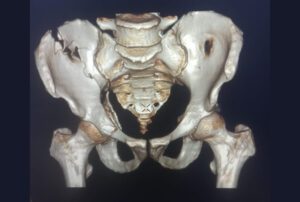 Pelvi – Acetabular Surgery