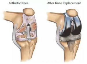 Knee Replacement Surgeon In Delhi