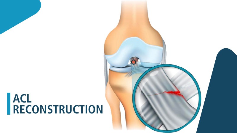 ACL ligament reconstruction surgery in Delhi 