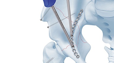 Complex Pelvi Acetabular Reconstructive Surgery