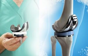 Knee Replacement Surgeon In Delhi