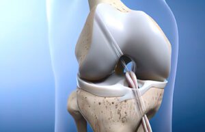 ACL Ligament Reconstruction Surgery in Delhi