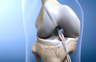 Acl Ligament Reconstruction Surgery
