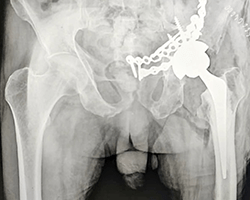 Complex Hip Replacement Surgery