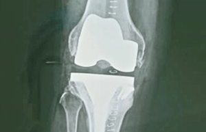 Complex primary knee replacement surgery
