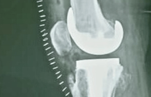 Complex primary knee replacement surgery