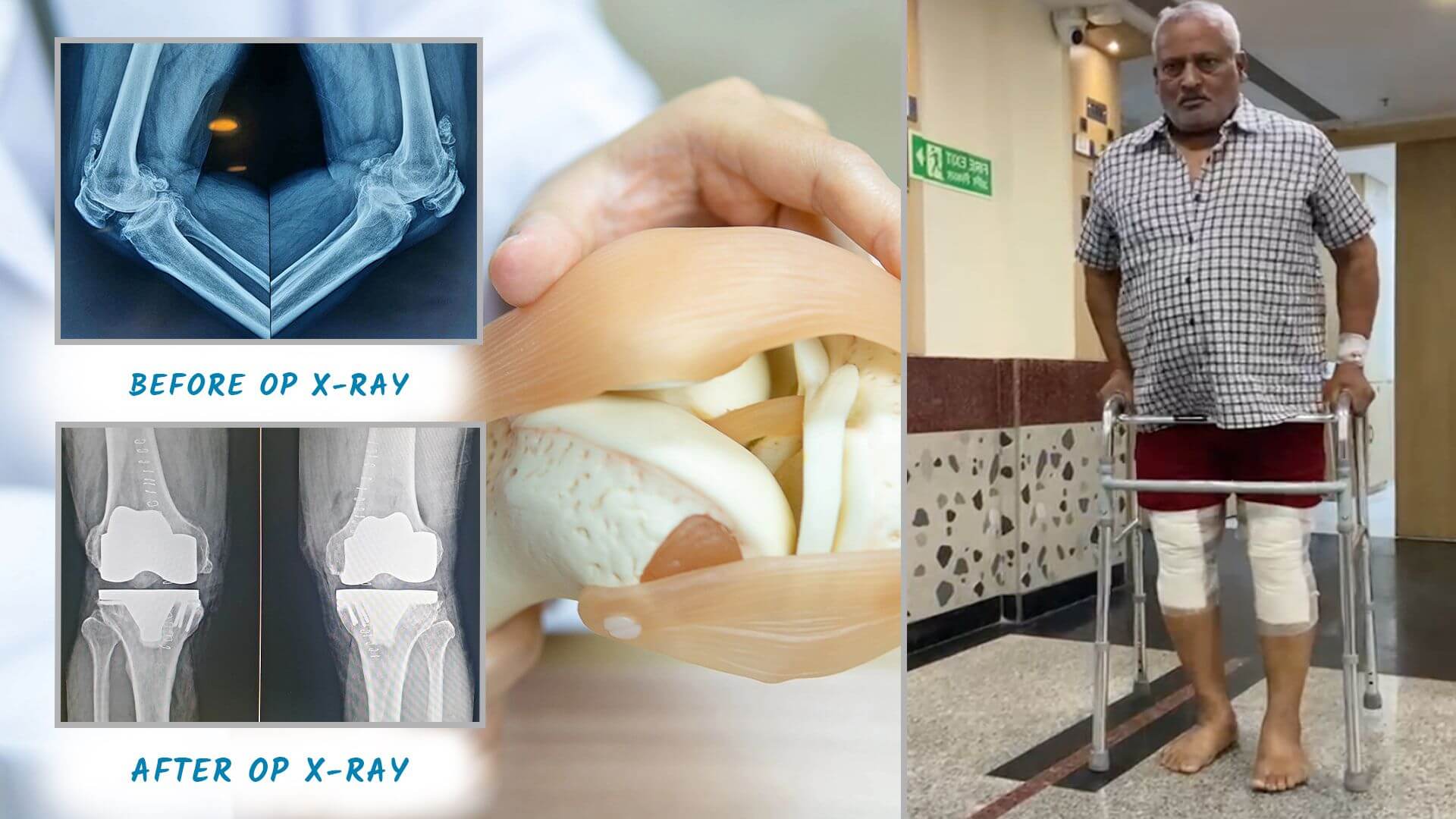 Knee Replacement Surgery by Dr. Nikhil Verma