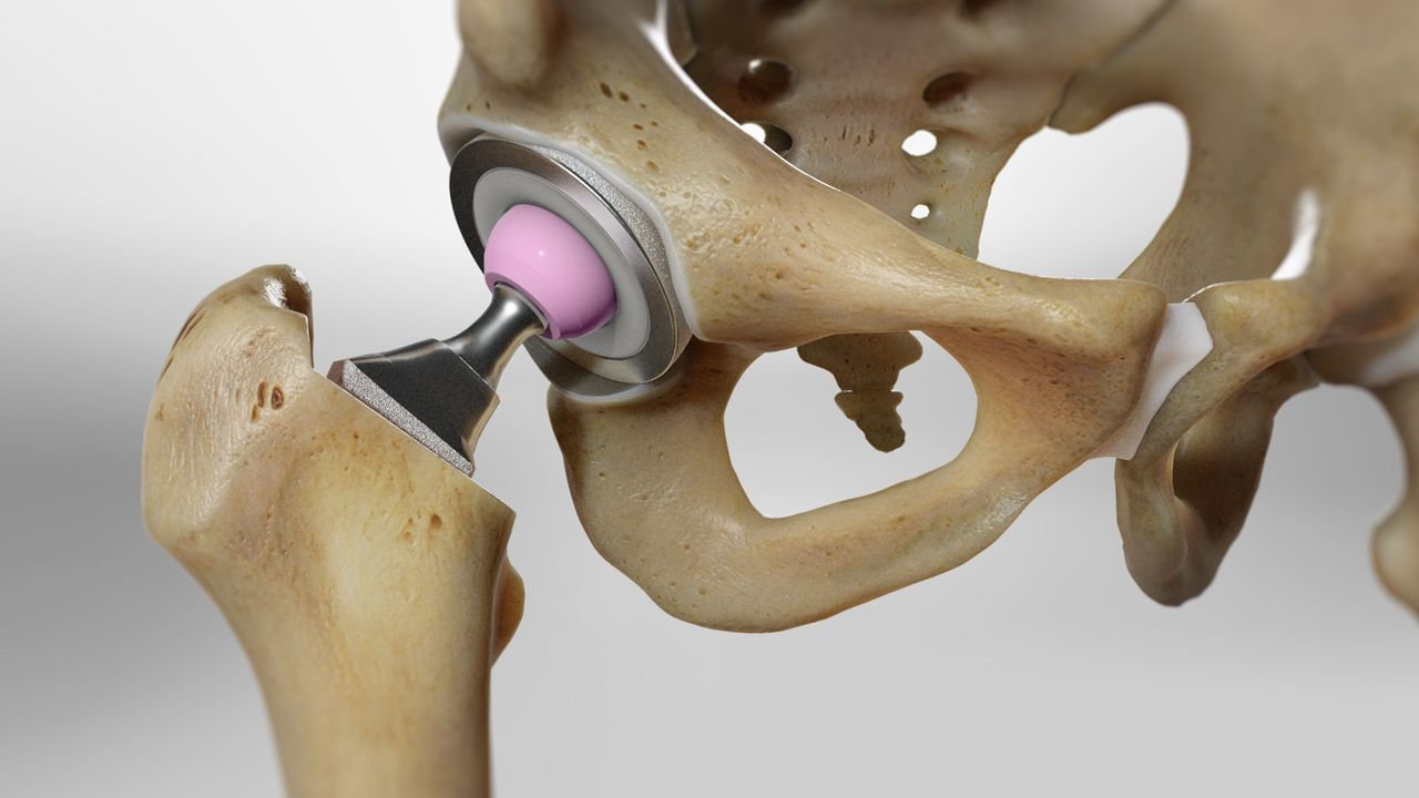 hip replacement surgeon in delhi