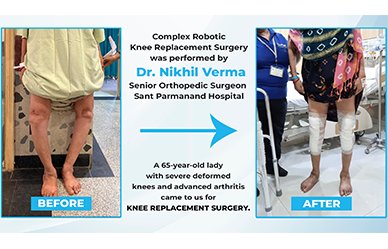 Complex Knee Replacement Surgery Using Robotic Assisted Arm
