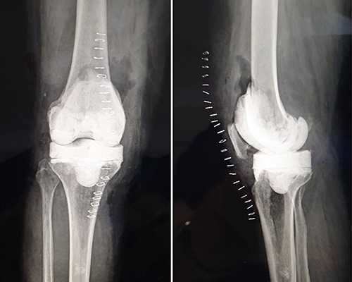 Periprosthetic joint infection