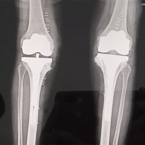 complex knee replacement