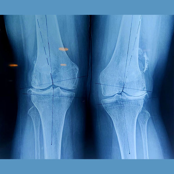 Complex Knee Replacement Surgery