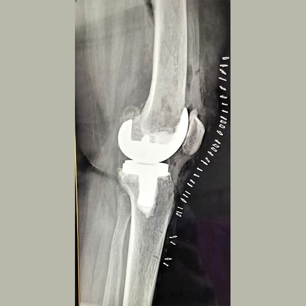 Complex Knee Replacement Surgery