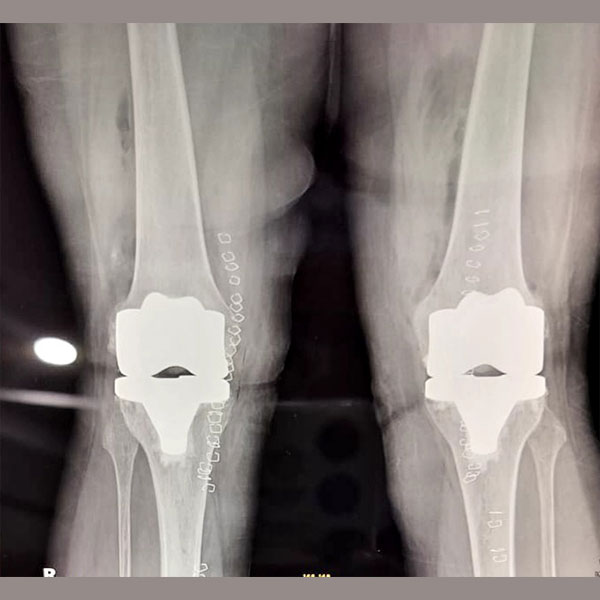 Complex Knee Replacement Surgery Case