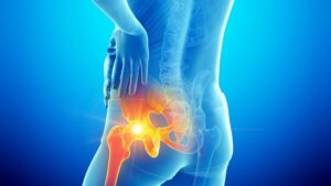 Hip Replacement Surgeon In Delhi