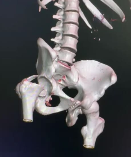 Complex Acetabular Hip Fracture Surgery