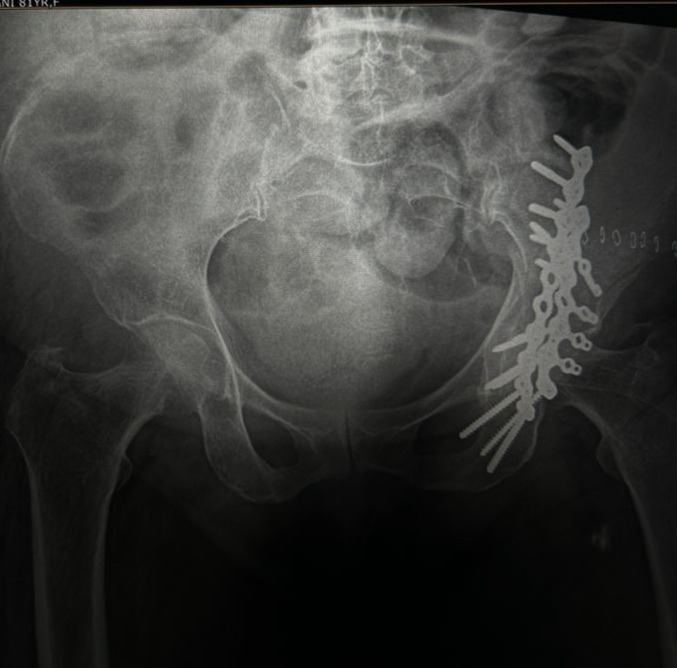 Pelvi-Acetabular-Surgery