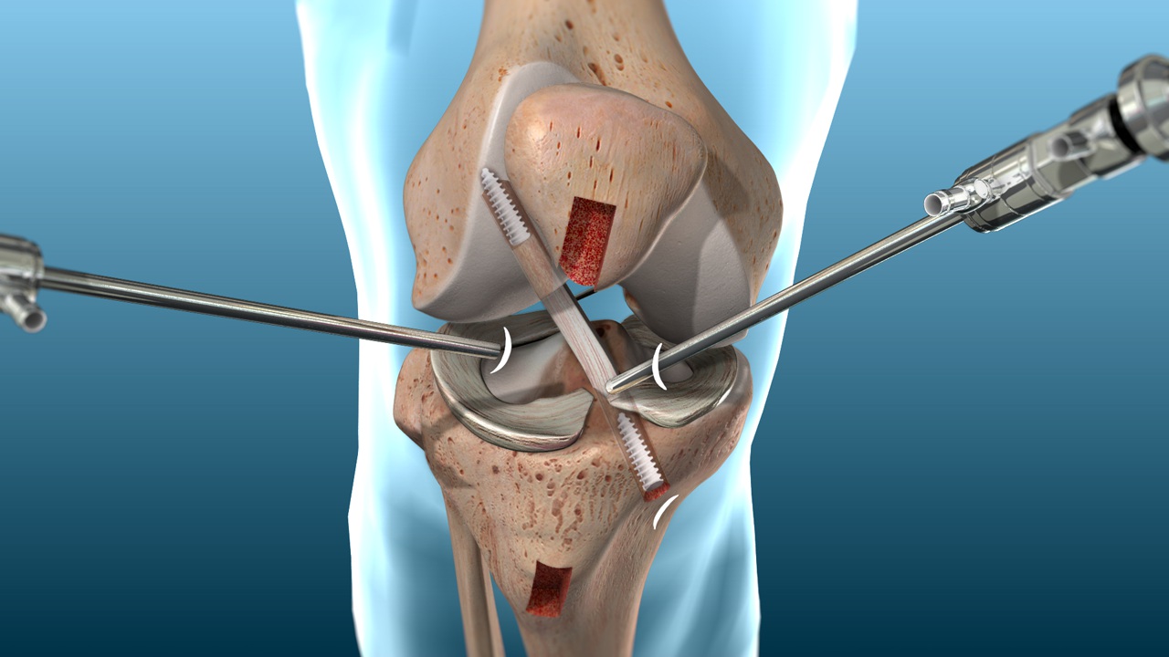ACL Ligament Reconstruction Surgery: A Comprehensive Guide