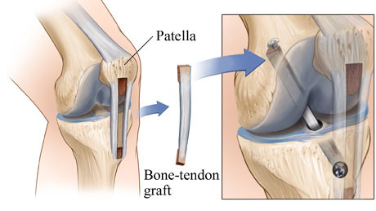 Comparing ACL Reconstruction Options: Autograft vs. Allograft